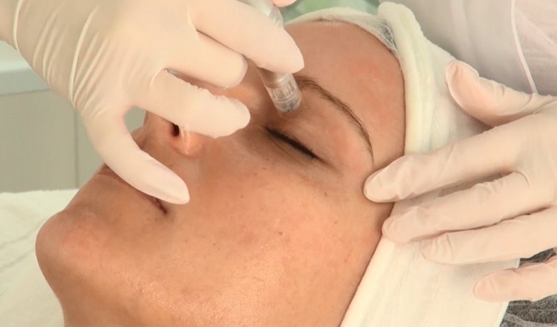 Microneedling Behandlung_2 Microneedling Behandlung_2