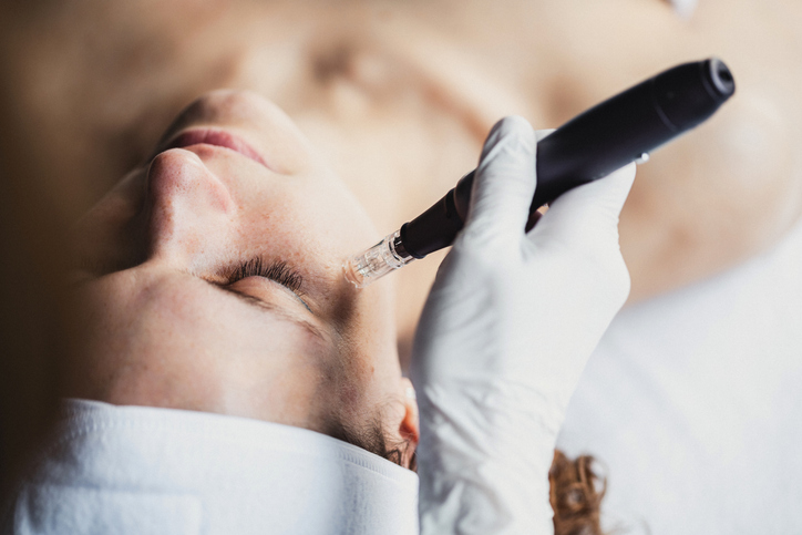 Microneedling microneedling