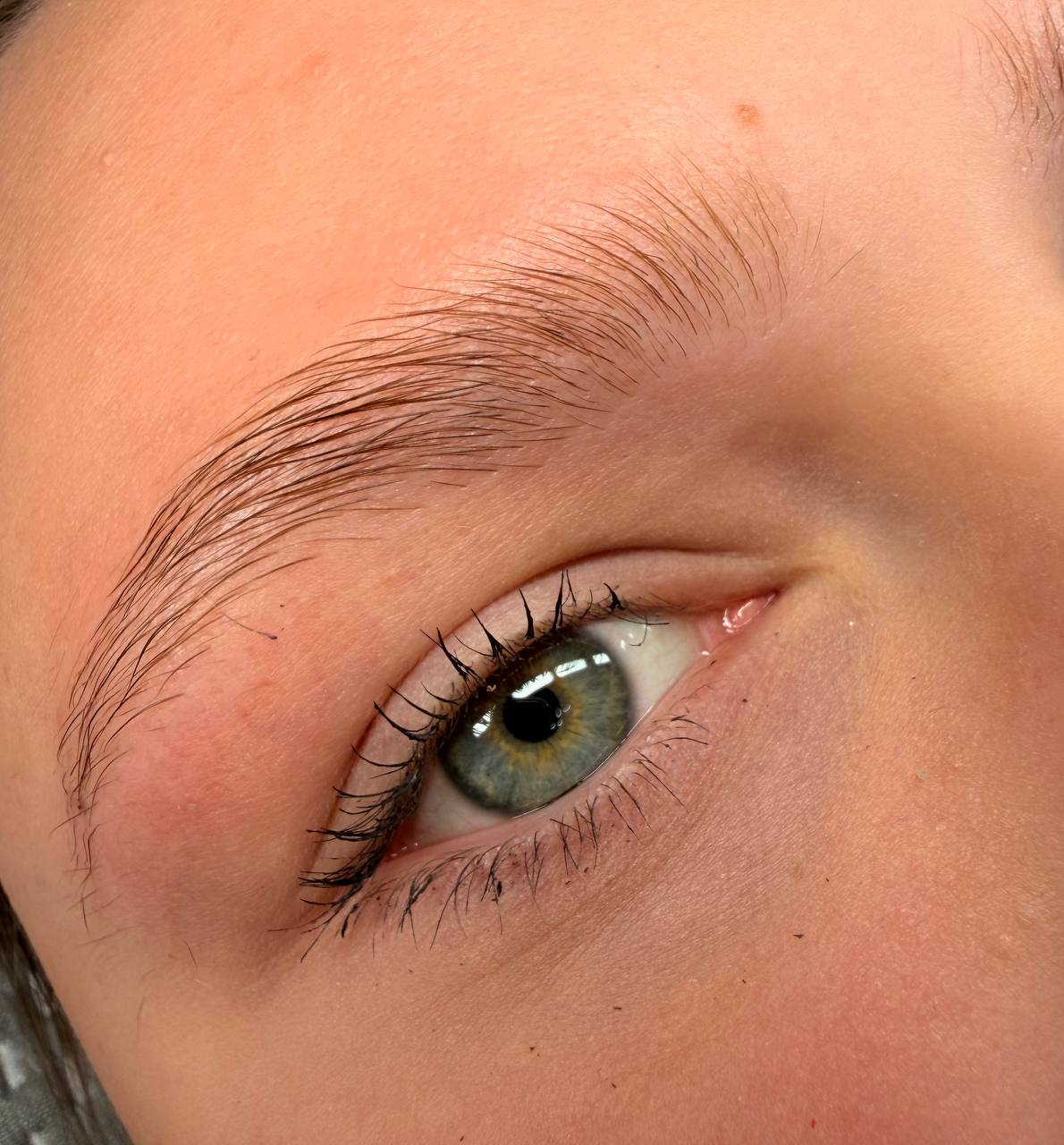 Brow Lifting Brow_Lifting